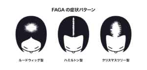 女性型脱毛症（FAGA）の症状パターン