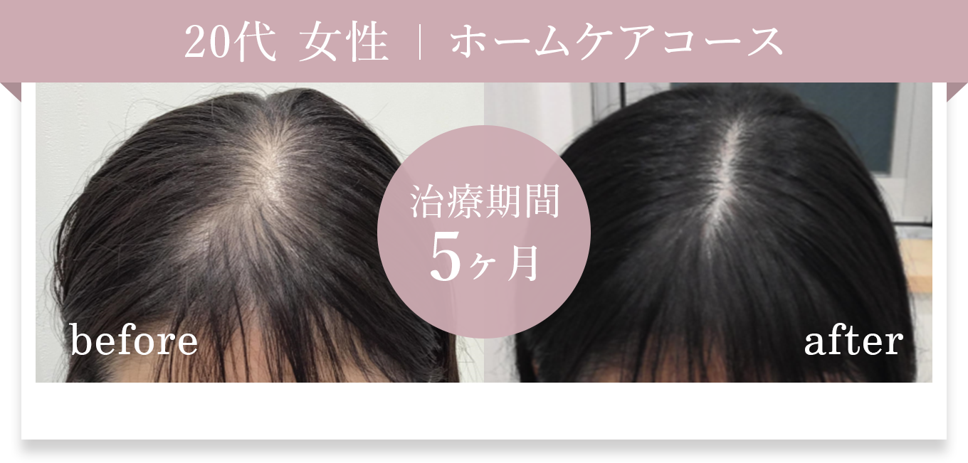 20代女性 ホームケアコース 治療期間5ヶ月