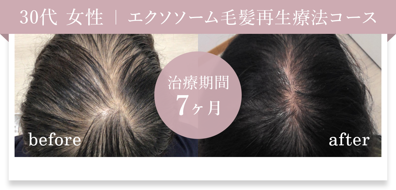 30代女性 エクソソーム毛髪再生療法コース 治療期間7ヶ月