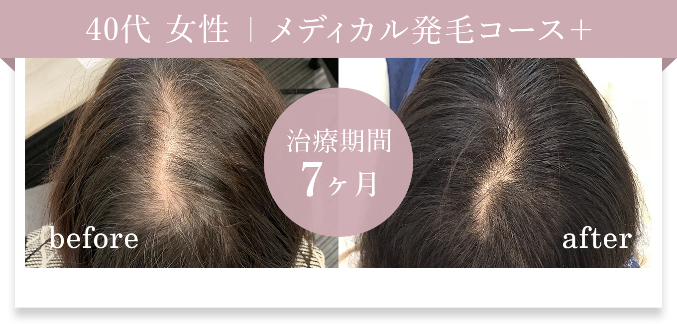 40代女性 メディカル発毛コース＋ 治療期間7ヶ月