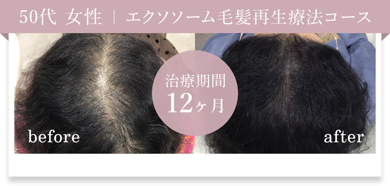 50代女性 エクソソーム毛髪再生療法コース 治療期間12ヶ月