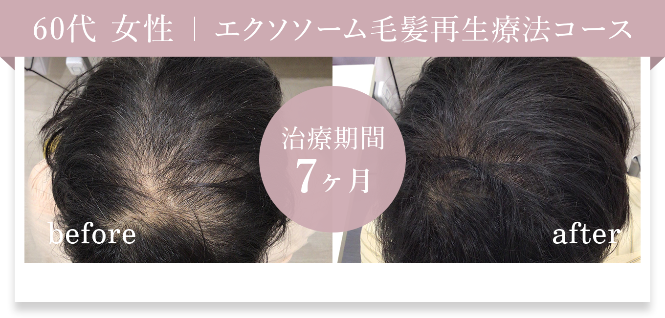 60代女性 エクソソーム毛髪再生療法コース 治療期間7ヶ月